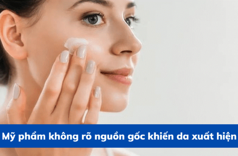 Nám da là gì? Dấu hiệu, nguyên nhân và cách điều trị hiệu quả